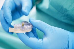 Dentist holding teeth model with metal dental implant