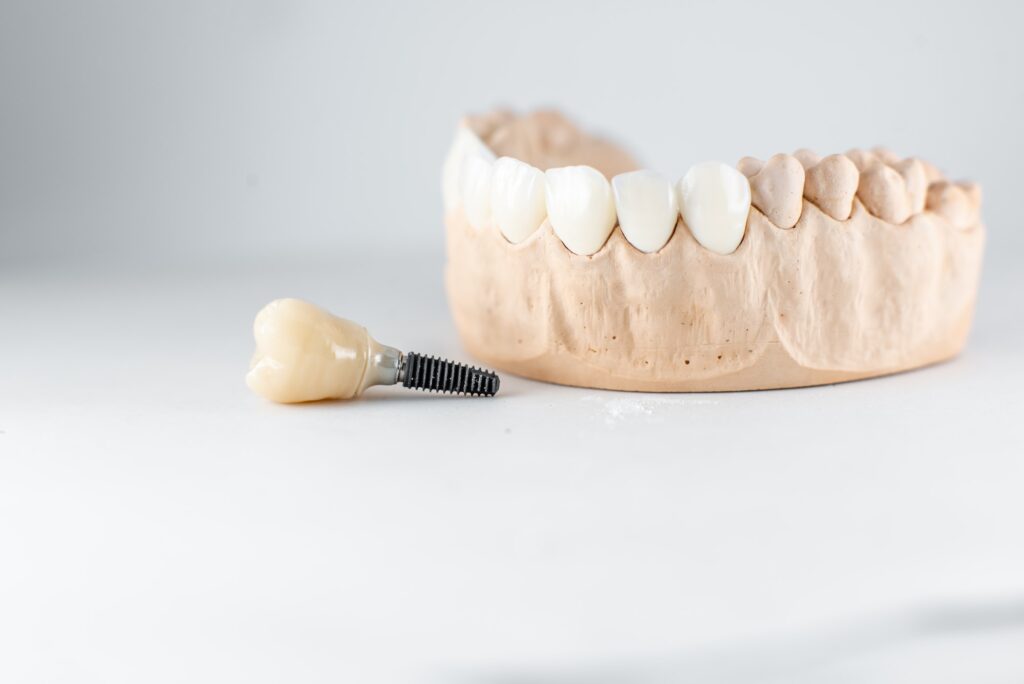 Model of artificial jaw and dental implant